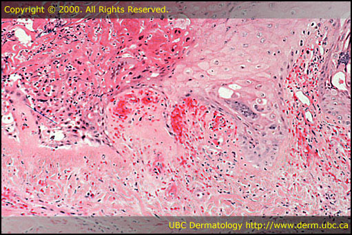 Dermatologic Pathology Flashcards - Course Hero