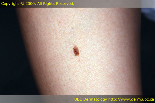 Melanocytic Nevus