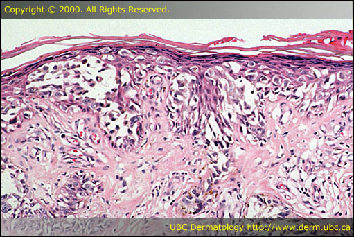 Melanoma