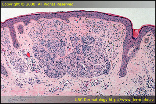 The Pathology of Dermatologic Conditions