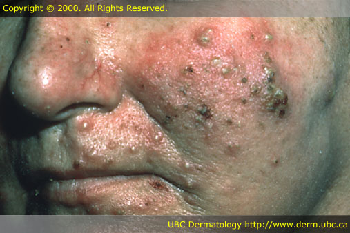 Rosacea