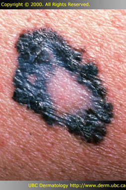 Melanoma