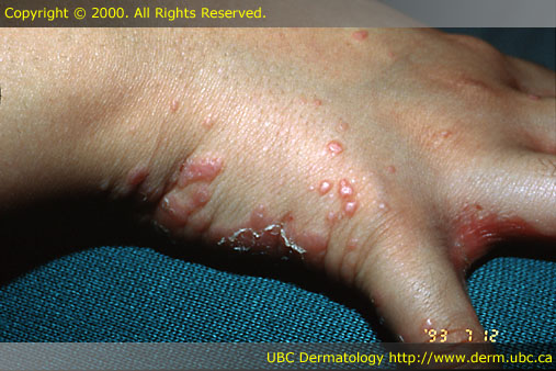 Lichen planus