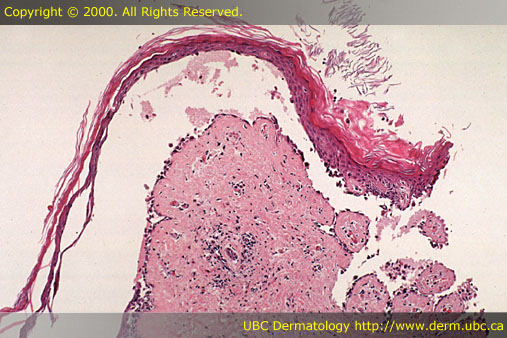 Neurofibroma