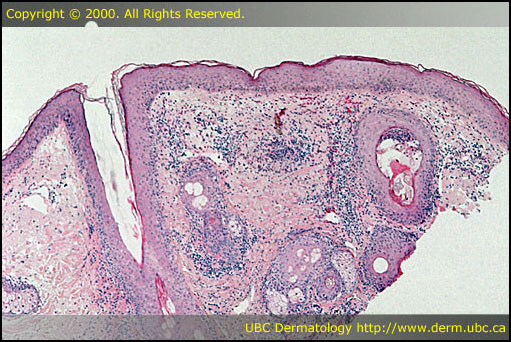 Rosacea