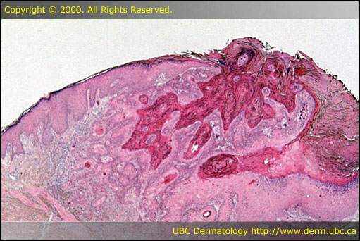 Squamous cell carcinoma