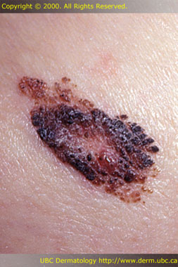 Seborrheic keratosis