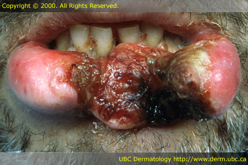 Squamous cell carcinoma