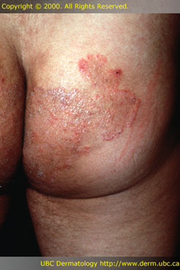 Types of ringworm: tinea corporis and tinea ... - MedicineNet