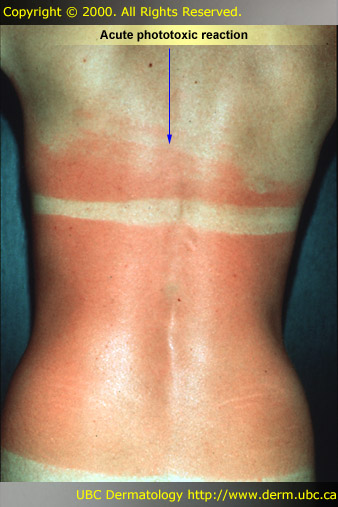 Sun-Sensitive Drugs (Photosensitivity to Drugs) Symptoms ...