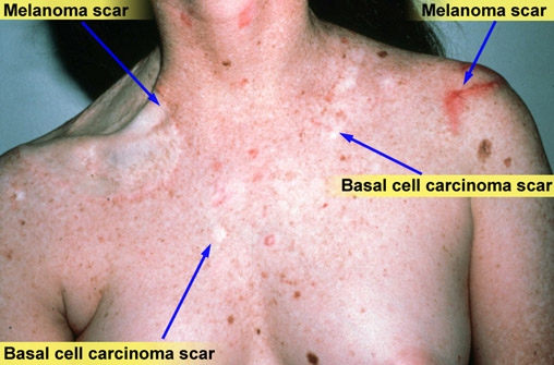 Xeroderma pigmentosum (age 20)