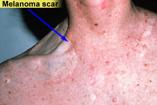 Xeroderma pigmentosum (age 20)