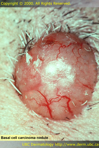 Basal Cell Carcinoma Nodule