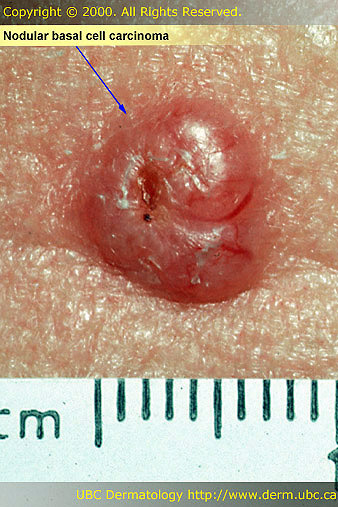 Nodular Basal Cell Carcinoma