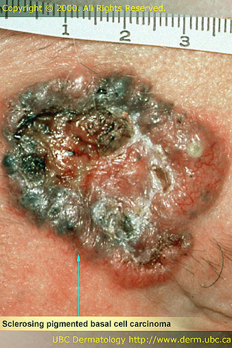Sclerosing Pigmented Basal Cell Carcinoma