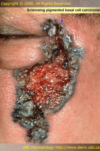 Sclerosing Pigmented Basal Cell Carcinoma