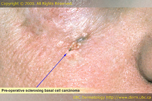 Pre-Operative Sclerosing Basal Cell Carcinoma