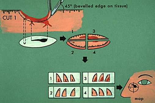 Micrographic Surgery