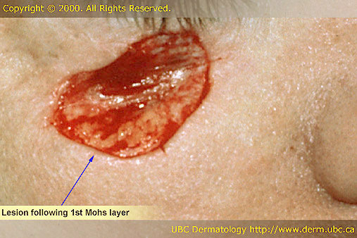Lesion following 1st Mohs layer