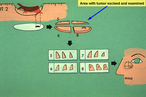 Micrographic Surgery