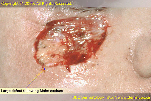 Large defect following Mohs excise