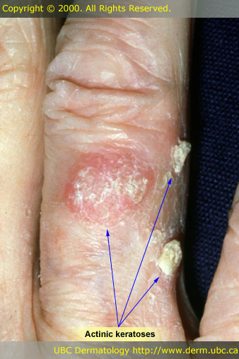 Actinic keratoses