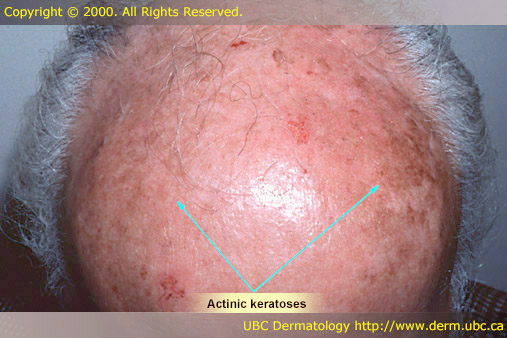 Actinic keratoses