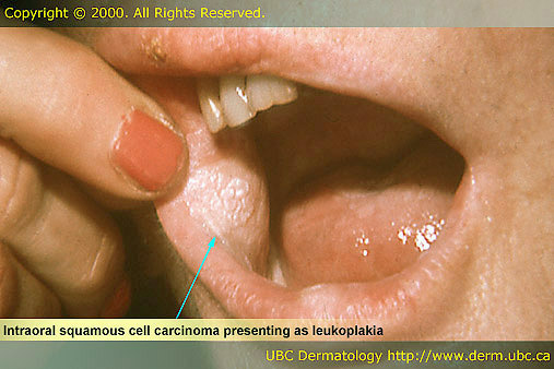 Intraoral squamous cell carcinoma presenting as leukoplakia