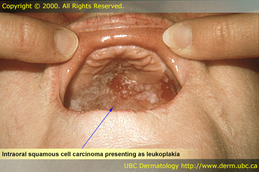 Intraoral squamous cell carcinoma presenting as leukoplakia