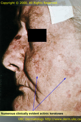 Numerous clinically evident actinic keratoses