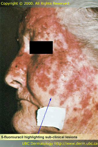 5-fluorouracil highlighting sub-clinical lesions