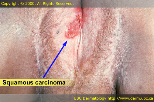 Squamous Carcinoma