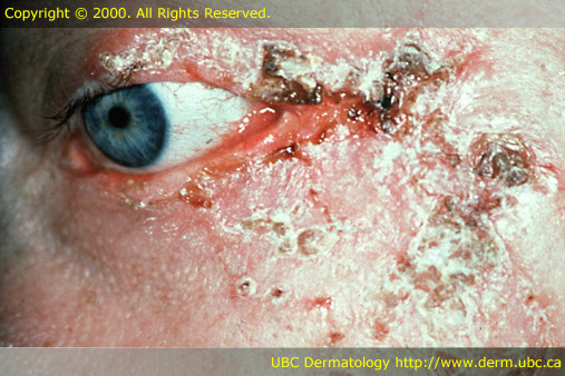 Squamous Carcinoma