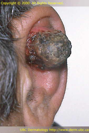 Squamous Carcinoma