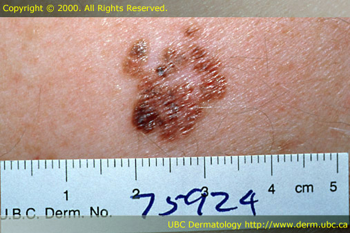 Superficial Spreading Melanoma