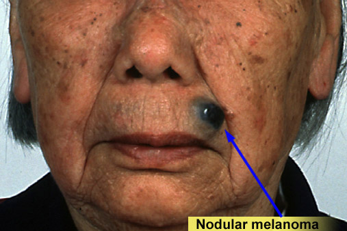 Nodular Melanoma