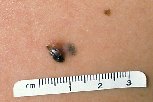 Superficial Spreading Melanoma