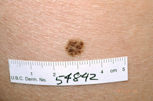 Atypical Nevus