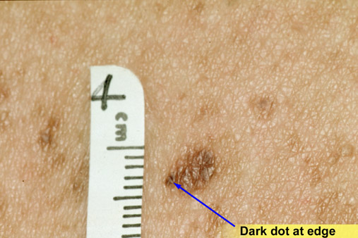 Atypical Nevus