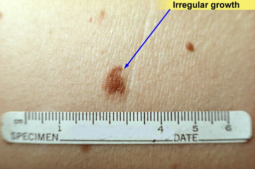 Atypical Nevus