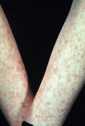 skin cancer freckles