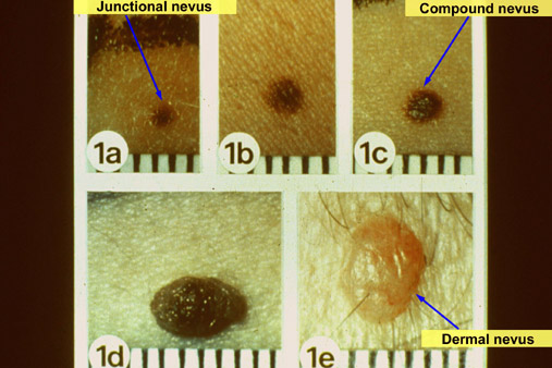 Life cycle of a nevus