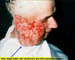 Very large basal cell carcinoma pre-micrographic surgery