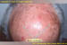 Actinic keratoses