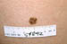 Atypical Nevus