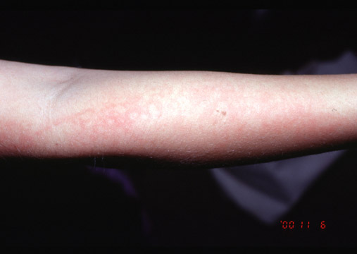 Fifth Disease