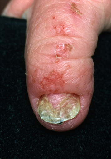 Candida Nail Dystrophy