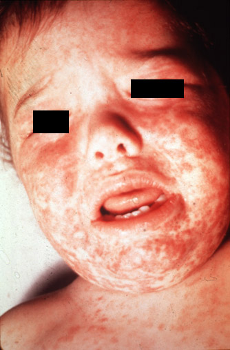 Measles