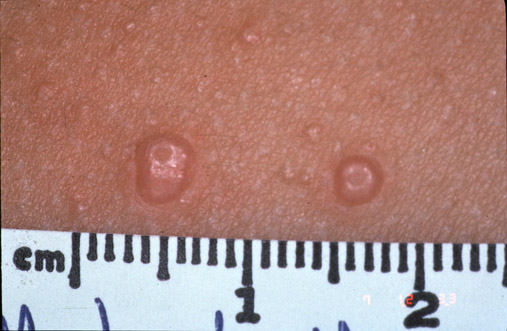 Molluscum contagiosum