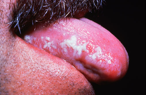 Oral leukoplakia in HIV patient